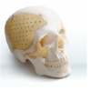 3D Patient Specific Mesh