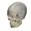3D Patient Specific Mesh - Image 2