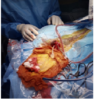Ventriculo-Peritoneal (VP) Shunt - Image 3